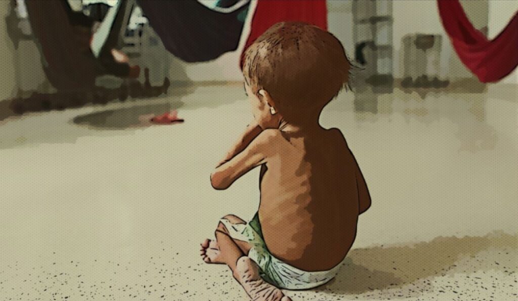 Niño desnutrición Desnutrición infantil La Libertad